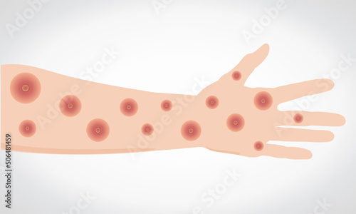 Monkeypox virus. Wounds on the hand and arm. Vectorial