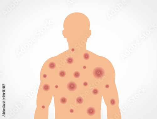 Monkeypox virus and alert against disease spread, symptoms. Monkey Pox virus outbreak.