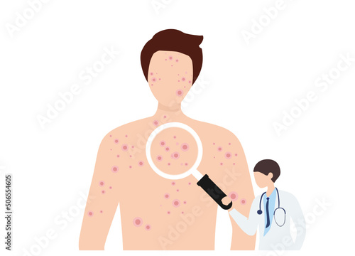 Man suffering from new virus Monkeypox infection vector illustration. Smallpox virus concept