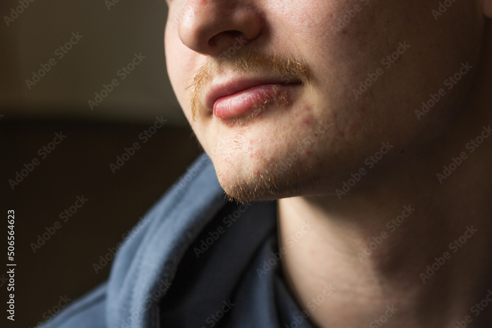 Close up portrait of man's lips infected herpes virus. Painful look. Skin care and daily hygiene concept. Close up portrait of man's lips infected herpes virus. Painful look. Skin care and daily hygiene concept.