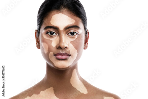 Beautiful South Asian woman with vitiligo skin disorder against white background photo