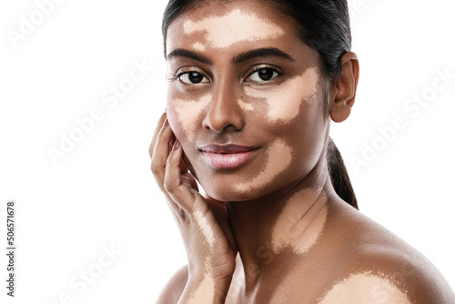 Beautiful South Asian woman with vitiligo skin disorder against white background photo