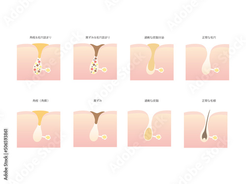 Canvastavla 毛穴汚れの種類のイラスト