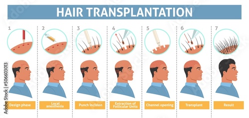 Male person hair transplantation step info poster