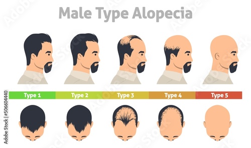 Male type alopecia poster hair loss stage photo