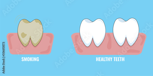 Smooking effect on teeth. . Vector illustration of white teeth compared to a yellow tooth caused by smoking. Dental care concept. 