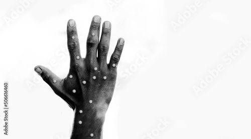 Monkeypox infection pandemic.African hand symptom monkeypox show doctor in laboratory lab confirm.Monkeypox is a rare disease infection with virus.Sexual Health.infection in Africa Europe.isolated. photo