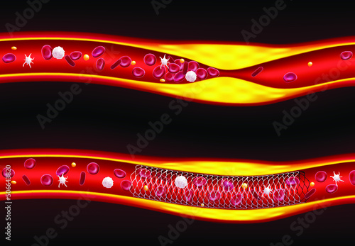 3D illustrations before and after stenting improve blood flow, atherosclerosis. medical use education and science