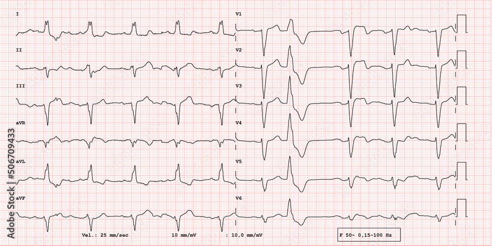 Pathological 12-lead ECG, right branch block, supraventricular premature beat, BAV atrioventricular block first degree, real exam Pathological 12-lead ECG, right branch block, supraventricular premature beat, BAV atrioventricular block first degree, real exam
