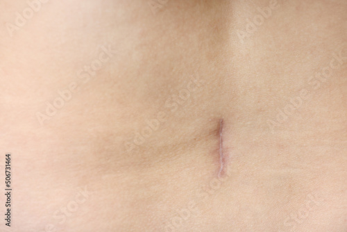close up of careful scar after surgery on the body.