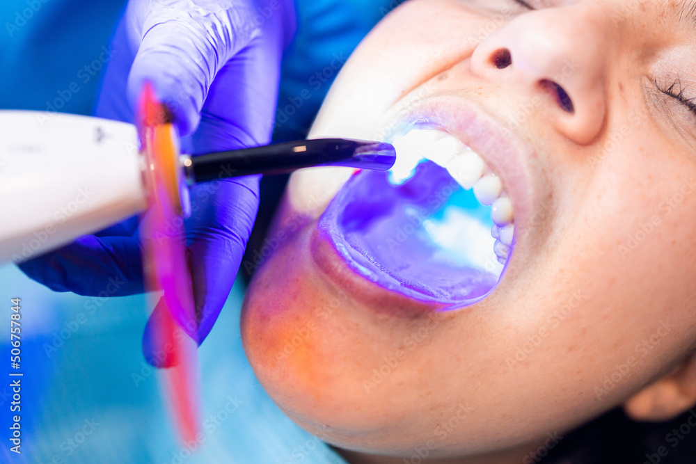 Tooth restoration with filling and polymerization lamp. Dental curing