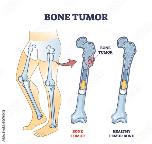 Bone tumor as abdominal tissue growth on human skeleton outline diagram. Labeled educational scheme with medical condition and healthy femur bones comparison vector illustration. Orthopedic problem.