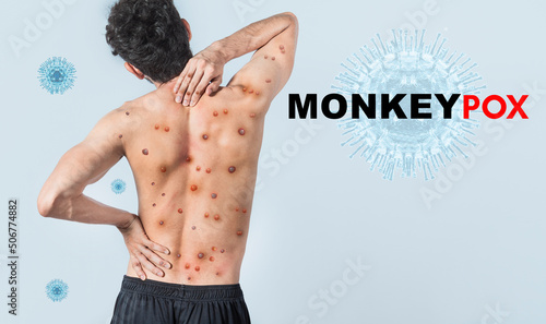 People with monkeypox on isolated background, A person from back with monkeypox on his body, Monkeypox virus concept, Monkeypox virus outbreak pandemic design photo