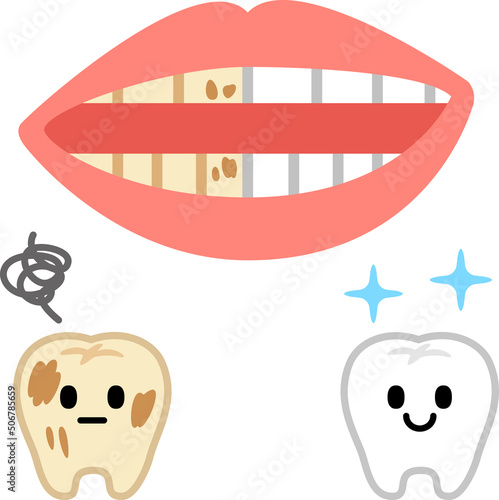 ステインが付いた歯と白い歯の比較