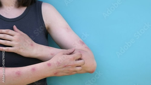 Wallpaper Mural Woman scratches her hands with rash, red spots blisters. Monkeypox new disease dangerous over the world. Patient with Monkey Pox. Close up rash, human with Health problem. Copy space Torontodigital.ca