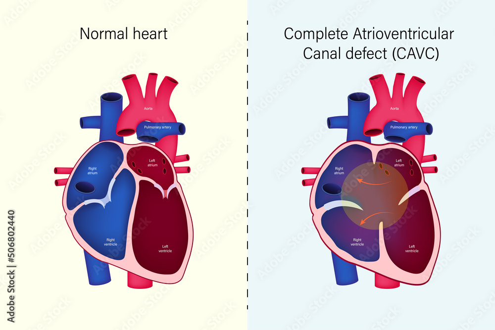 The Difference Of Normal Heart And Complete Atrioventricular Canal Defect Cavc Vector