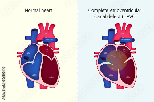 The difference of Normal heart and Complete Atrioventricular Canal defect (CAVC) vector. Congenital heart disease.