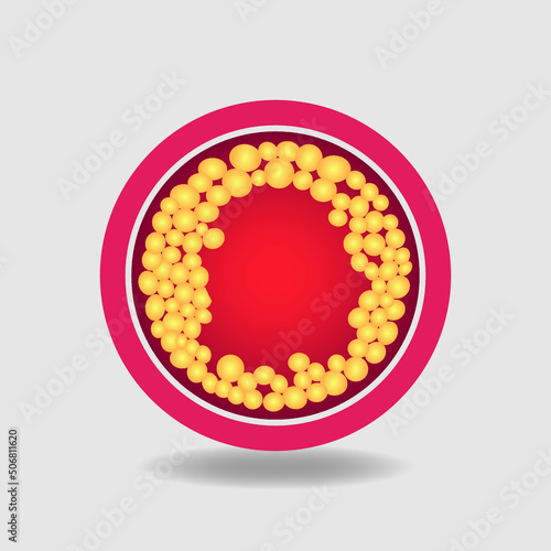 Blood Clot Human artery clot