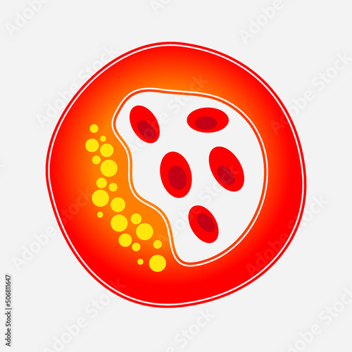 Blood Clot Human artery clot