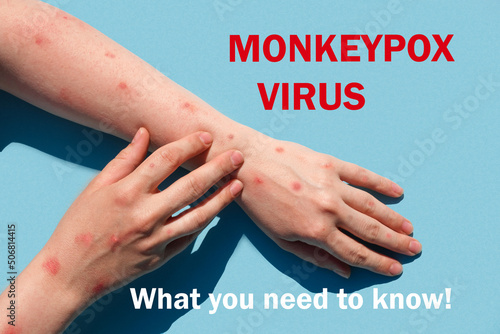 Phrase MONKEYPOX VIRUS what you need to know. Monkeypox new disease dangerous over the world. Patient with Monkey Pox. Painful rash, red spots blisters. Close up human hands with Health problem