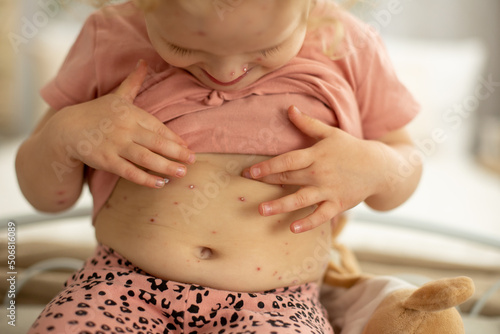 Fotografie Little toddler girl with chicken pox in bed, playing at home, quarantine isolati