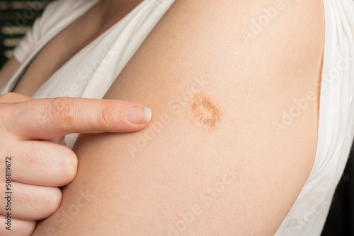 Obraz na plátně Monkeypox and smallpox vaccine scar on a woman's left arm