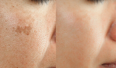 Cropped Image before and after spot melasma pigmentation facial treatment on middle age asian woman face. skincare and health problem concept.
