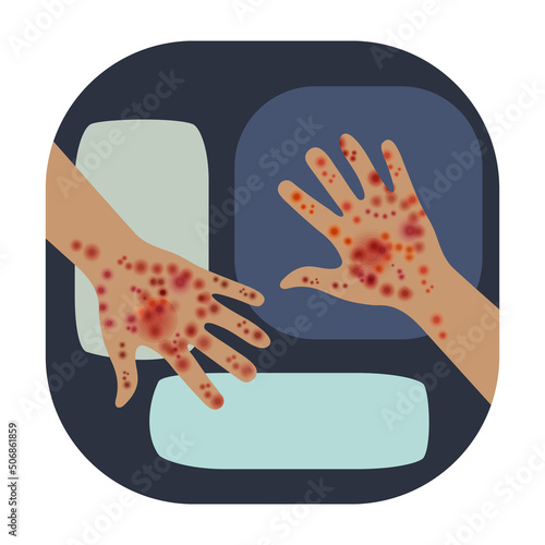 Painful rash covers arms with blisters and crusts. Infectious disease caused by monkeypox virus. Disease similar to chickenpox, measles or smallpox. Skin infections, scabies and drug allergies.