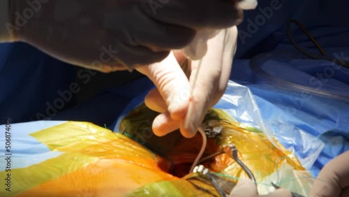 The neurosurgeon performs ventriculo-peritoneal shunting. Shunt medical conductor. Surgery for ventriculo-peritoneal shunting with a shunt guide.