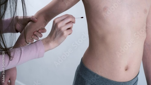 Mom lubricates the rash from chickenpox on son's body and abdomen with with red antiseptic using cotton buds.11-year-old boy suffers from chickenpox. Varicella blisters applying with antiseptic drug,