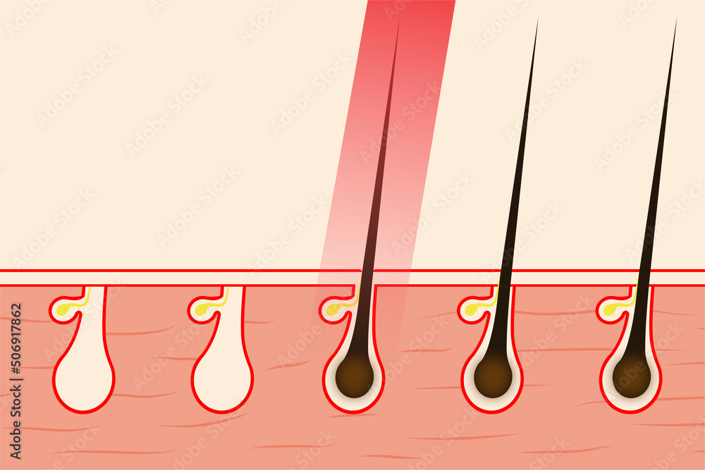 Removing hair with red laser light vector illustration. Removing body