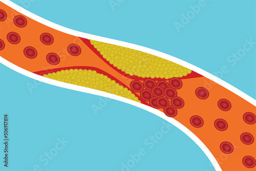 Blood circulation vessels are blocked by extra body fat. Red blood cells are blocked by yellow fat inside an artery. Human anatomy and blood clotting concept vector illustration. Heart diseases.