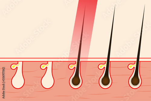 Removing hair with red laser light vector illustration. Removing body hair from the hair root by using laser treatment. Beauty salon works information and hair removal concept vector.