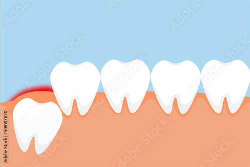 A wisdom tooth erupts through the gum and gives a red pain signal concept. Dangerous wisdom toothache causes gum pain vector. Tooth pushing from the inside and giving pain to the gum.