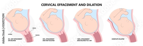 Cervical effaces and Dilatation vagina delivery labor fetal birth giving stage cervix uterine Left vertex mucus plug exam early baby thin