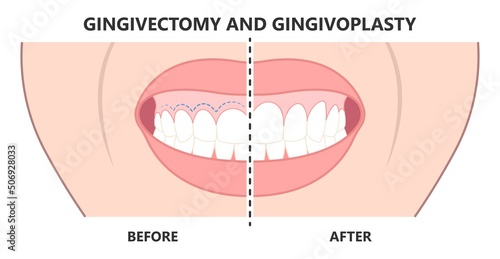Gingivectomy gum graft smile small teeth deep cleaning prep flap dental attached gingiva alveolar bone laser tooth Care lift tissue treat clean plaque bacteria Tartar calculus photo