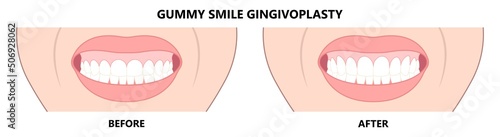 Gingivectomy gum graft smile small teeth deep cleaning prep flap dental attached gingiva alveolar bone laser tooth Care lift tissue treat clean plaque bacteria Tartar calculus