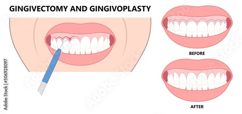 Gingivectomy gum graft smile small teeth deep cleaning prep flap dental attached gingiva alveolar bone laser tooth Care lift tissue treat clean plaque bacteria Tartar calculus photo