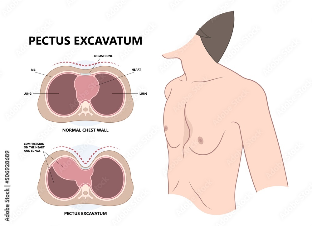 Chest wall disorder and Pectus ribs sunken funnel heart murmur lung