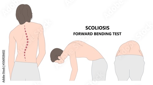 spine forward head posture chest xray neck pain lumbar Scheuermann's body discs brace sway back adam's spinal birth defect fracture cobb angle bone curved vertebrae cancer bend test exam kyphoplasty