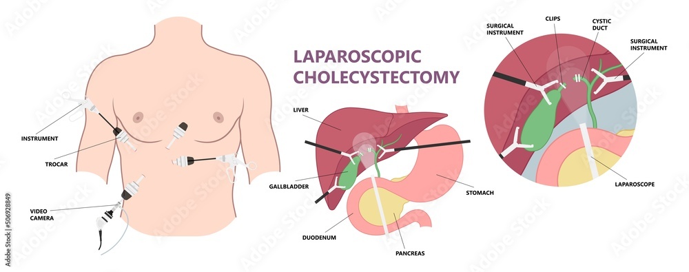 gallbladder cystic bile duct cancer pain drain polyps fine needle test and chole diagnose obstructive Acute tract stones gallbladder cystic bile duct cancer pain drain polyps fine needle test and chole diagnose obstructive Acute tract stones