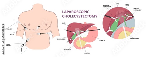 gallbladder cystic bile duct cancer pain drain polyps fine needle test and chole diagnose  obstructive Acute tract stones
