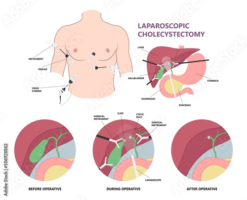 gallbladder cystic bile duct cancer pain drain polyps fine needle test and chole diagnose  obstructive Acute tract stones