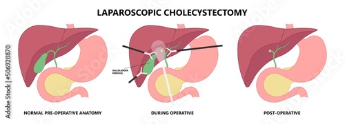 gallbladder cystic bile duct cancer pain drain polyps fine needle test and chole diagnose  obstructive Acute tract stones photo