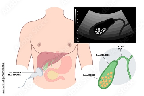 gallbladder cystic bile duct cancer pain drain polyps fine needle test and chole diagnose obstructive Acute tract stones photo