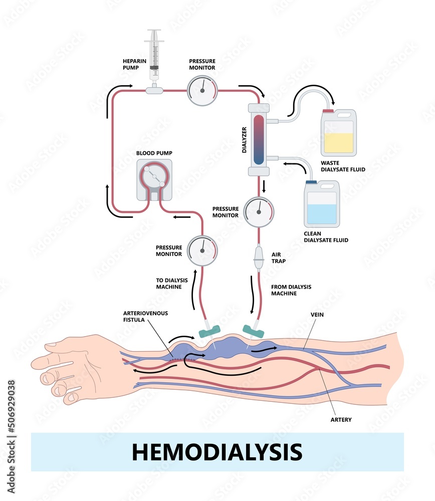 Vascular access for kidney graft shunt lumen with PICC line tube chest ...
