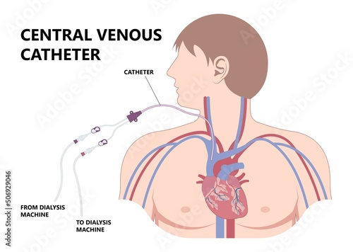 Vascular access for kidney graft shunt lumen with PICC line tube chest care artery vein arm Blood vessel flow neck liver and CRRT intravenous injection Total Nutrition