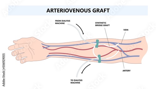 Vascular access for kidney graft shunt lumen with PICC line tube chest care artery vein arm Blood vessel flow neck liver and CRRT intravenous injection Total Nutrition photo