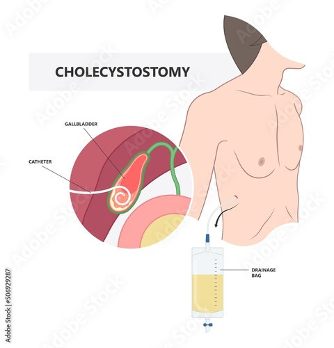 stent acute guided with ERCP and ERGD drain surgical laparoscopy tube bile duct stone bag liver blocked obstruction pain yellow skin eye remove examine cancer colic injury rupture tumor