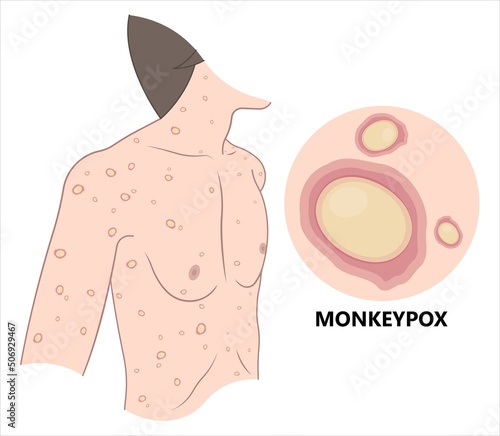 Monkeypox virus genus rash spots body skin Scabs zoonoses sick Transmission outbreak rats mice life cycle